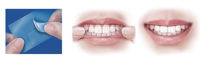 Anwendung und Ergebnis der Oral-B 3D Whitestrips