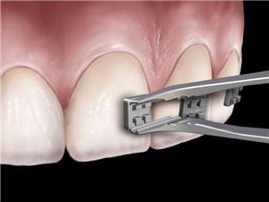 Ultra Slim Bracket-Platzierpinzette Pinzette