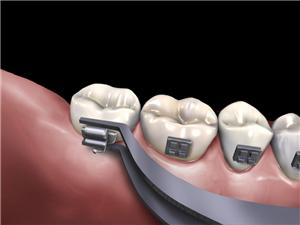 Ultra Slim Bukkalröhrchen-Platzierpinzette Pinzette