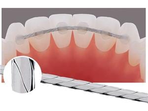 Geflochtener Retainer-Draht Packung 10 Stück