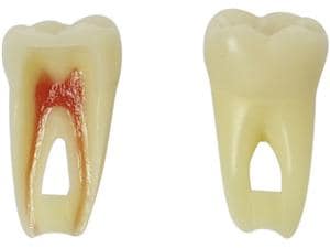 Endo-Modellzahn mit Schraube Zahn 36
