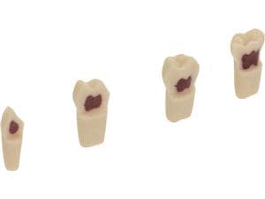 Milchzahn mit Pulpa-Cavum Zahn 54