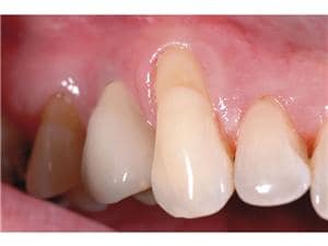 Amaris® Gingiva - Einzelpackung Nature, Spritze 4 g