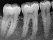 intraorales-roentgen