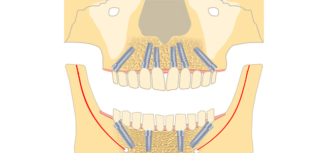Angulationskonzenpt Oberkiefer Unterkiefer Ausschnitt