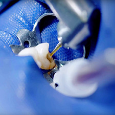 Probleme in der Endodontie vermeiden und lösen. Neue Veranstaltungsreihe von Henry Schein