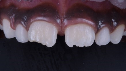 Adhäsiv-Applikation.
Klebefläche an Zahn 11 nach der Applikation von 3M Scotchbond Universal Plus Adhäsiv. Das Adhäsiv wurde zuvor mit einem LED-Polymerisationsgerät für zehn Sekunden lichtgehärtet.
